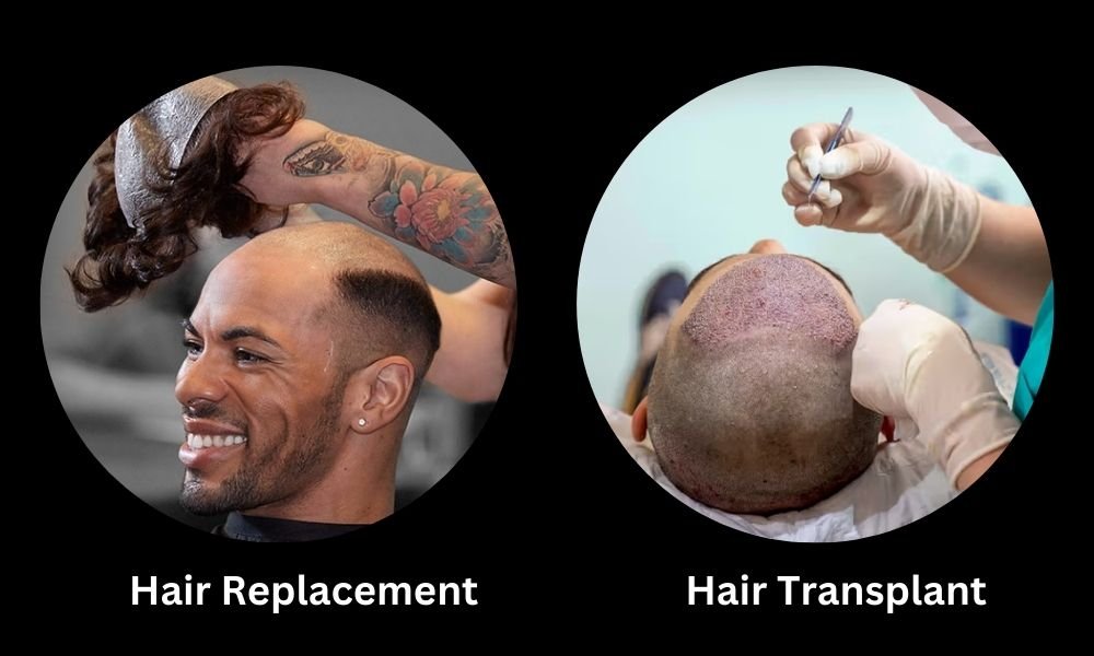 Hair Replacement and Hair Transplant