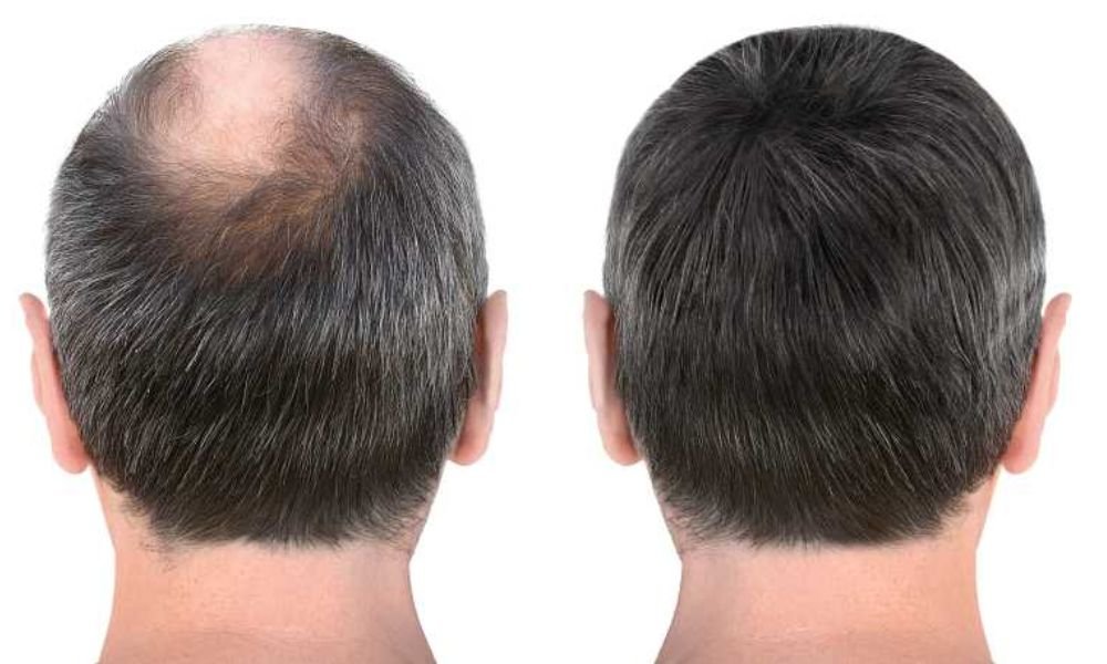 Non-Surgical Hair Replacement (1)
